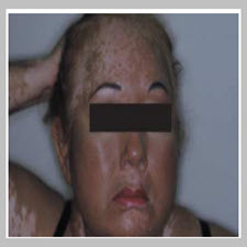 Treatment of vitiligo with broadband ultraviolet B and vitamins[taliem.ir]